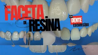 Faceta de Resina Composta em Dente Escurecido [upl. by Nunnery]