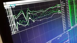 Dwave intraoperative neuromonitoring in Iceland Meningocele [upl. by Laband]