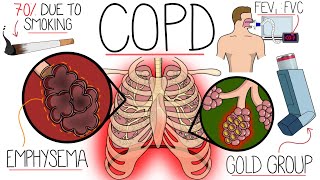 Understanding Chronic Obstructive Pulmonary Disease COPD Explained Clearly [upl. by Elva]