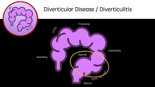 Diverticular Disease and Diverticulitis [upl. by Fleisig671]