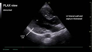 PoCUS Echo  Hypertrophic Cardiomyopathy HCM [upl. by Macdonell48]