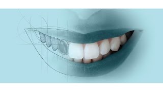 Porcelain Veneers Vs Composite Veneers [upl. by Branscum]