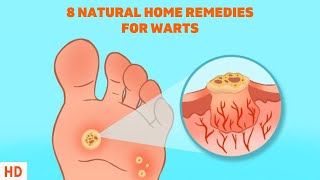 8 Surprising Home Remedies for Warts  Get Rid of Them Naturally [upl. by Lunetta]