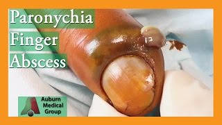 Paronychia Fingernail Abscess Infection Treatment  Auburn Medical Group [upl. by Atiuqel]