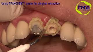 Using Traxodent® paste for gingival retraction [upl. by Vyky]