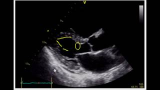 Estimating Ejection Fraction with Point of Care Echo [upl. by Roxana883]