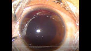 Traumatic Hyphema  Hyphemectomy Under Topical Anesthesia Unedited HD [upl. by Rentschler273]