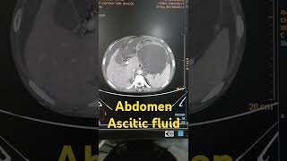 Abdomen ascitic fluid abdomen abdomenascitic shorts viralshorts [upl. by Alverta438]