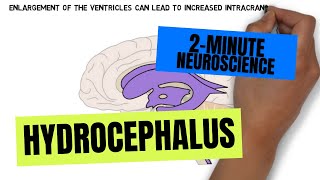 2Minute Neuroscience Hydrocephalus [upl. by Irt]