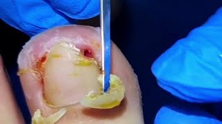 Patient Screams When Huge Ingrown Toenails Get Pulled By Pedicurist [upl. by Eilegna]