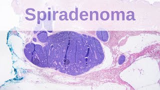 Eccrine Spiradenoma  Pathology mini tutorial [upl. by Sebastiano291]