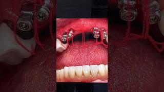 Creating a Full Mouth Restoration for a Dentist’s Mother dental smile teeth shorts shortvideo [upl. by Yardna341]