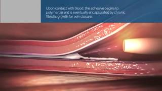 VenaSeal Treatment for Varicose Veins in Middle Georgia [upl. by Nylegna]