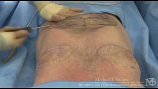 Ultrasonic liposuction of a mans chest and abdomen [upl. by Aniwde]