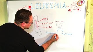 سرطانات الدم leukemia AML ALL CLL CML blast cells [upl. by Broderick]