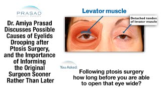 What to Expect after Congenital Ptosis Surgery and its Possible Complications [upl. by Einttirb]