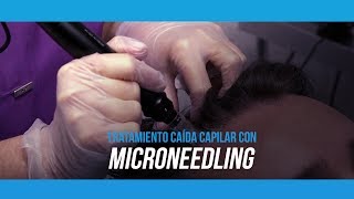 Tratamiento caída cabello con Microneedling [upl. by Lupee]