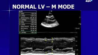 Assessing Left Ventricular Function [upl. by Eirol]