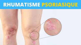 Le rhumatisme psoriasique expliqué en 1 minute [upl. by Edgardo]