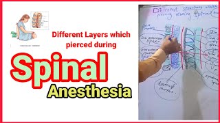 Layers which pierced during spinal anesthesia anaesthesiawithbabar2576 [upl. by Merrick]