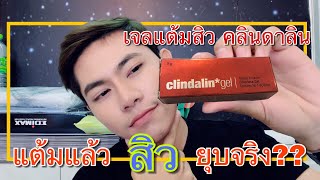 รีวิว  เจลแต้มสิว คลินดาลิน สิวยุบจริง AEK WICTCHARNKUL [upl. by Kulseth]