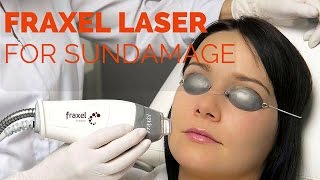 Fraxel Fractional laser resurfacing [upl. by Githens]