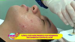 Limpieza facial para Combatir el Acné  Clínica Chávarri [upl. by Etessil]