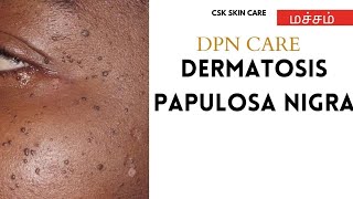 CSKIN உணர்வோம் DERMATOSIS PAPULOSA NIGRA TAMIL DPN NATURAL CARE மச்சம் MOLESKINTAG NATURAL CARE [upl. by Scutt874]