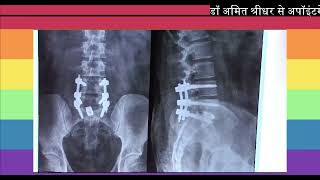 Listhesis at L5S1 and nerve compression  Spine Surgery Case Patients Testimonial DrAmit Shridhar [upl. by Cormack584]