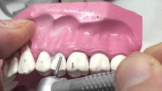 PFM second premolar preparation 1 [upl. by Locklin]