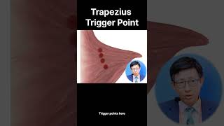 Trapezius trigger point [upl. by Blank]