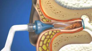 Bionix® OtoClear® Ear Irrigation [upl. by Strawn706]