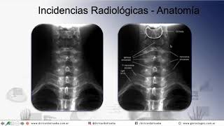 VALORACIÓN RADIOLÓGICA DEL TRAUMATISMO CERVICAL [upl. by Arval636]