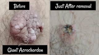 Skin tag removal मस्से का ईलाज मशीन द्वारा Giant Acrochordon treatment by ElectrocauteryRadiofreq [upl. by Annekam]