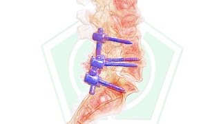 Artrodesis lumbar transpedicular [upl. by Sucerdor]