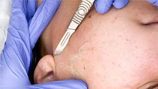 Satisfying Dermaplaning with ASMR sounds [upl. by Felita343]