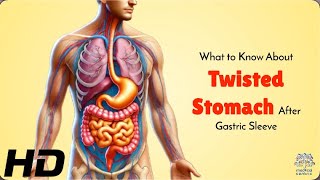 Twisted Stomach After Gastric Surgery What You MUST Know [upl. by Beera985]