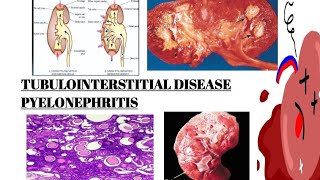 PYELONEPHRITIS  TUBULOINTERSTITIAL DISEASE PART 2  IMAGES  MCQs [upl. by Soll]