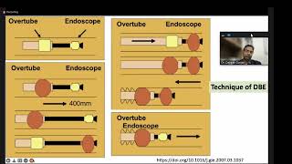 Endoscopy lectures Enteroscopy amp Polypectomy [upl. by Egidius]