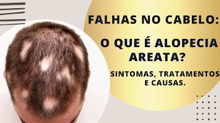 O que é alopecia areata sintomas causas e tratamento [upl. by Coe]