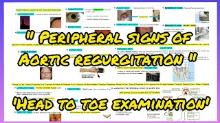 All PERIPHERAL SIGNS OF AORTIC REGURGITATION  DE MUSSETS SIGN  DUROZIEZ SIGN  WATER HAMMER PULSE [upl. by Yerhcaz]