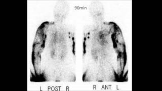 Lymphoscintigraphy for lymphedema patients Lymphatic Surgery in Japan [upl. by Latrina410]