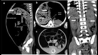 Pneumatosis intestinalis und tödliche portosystemische Luftembolie [upl. by Llennoj617]