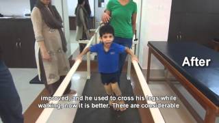 Spastic Quadriplegic Cerebral Palsy Treatment Result [upl. by Witha]