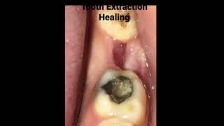 Tooth extraction healing Timelapse [upl. by Eerdna415]