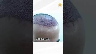 Hair Transplant for a Japanese Patient  HAIR TRANSPLANT MALAYSIA [upl. by Winters]