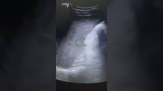 Hepatic calcification on USGcomedy usg trending baby usgsfactsviralvideoshorts youtubeshort [upl. by Attelrahs]