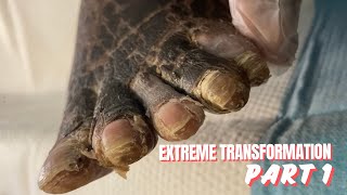 EXTREME FOOT TRANSFORMATION  PART 1 [upl. by Mali884]