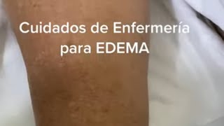 Edema Cuidados de Enfermería [upl. by Uird]