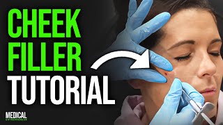 Cheek FIller for the Perfect MidFace Lift  Full Procedure Demonstration [upl. by Levy]